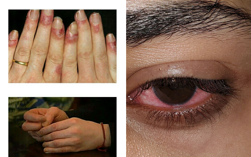 Acetone có thể gây đỏ mắt và rát da