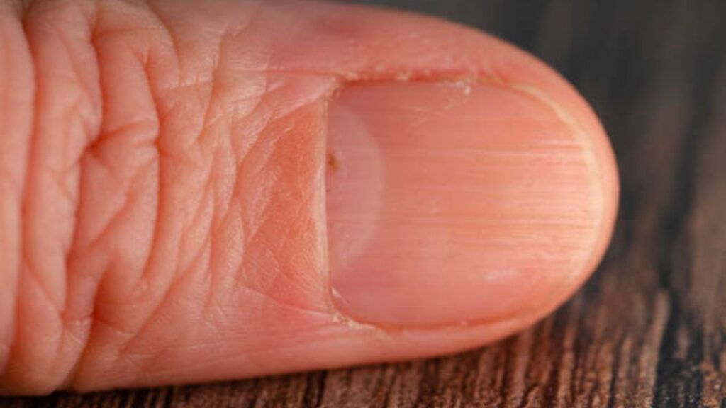 Móng tay bị sọc dọc