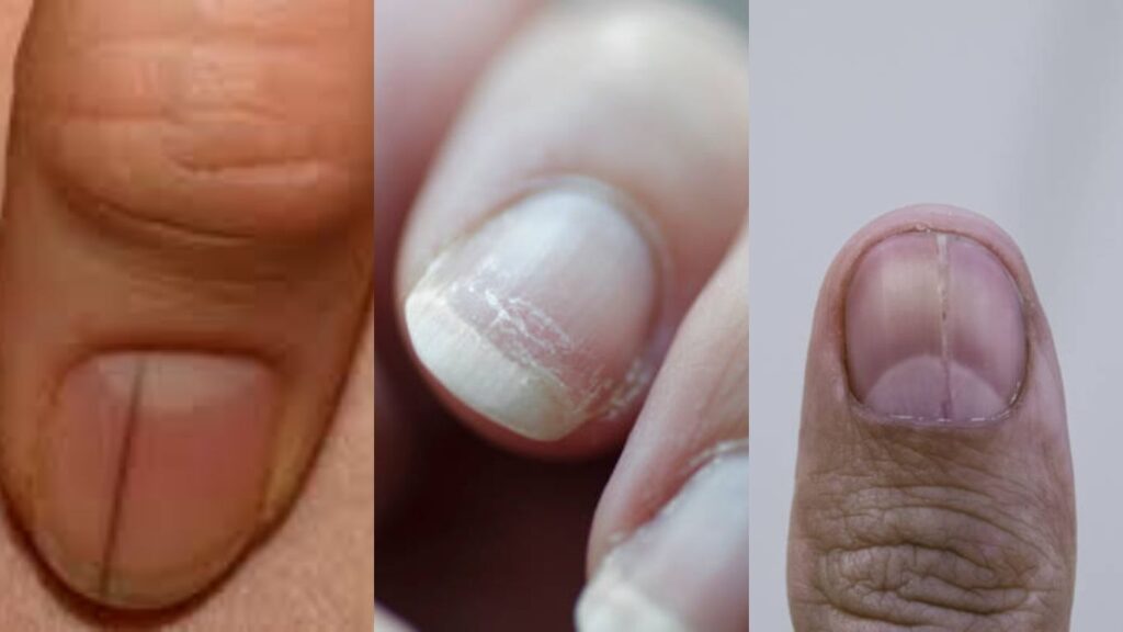 Một số loại sọc móng tay phổ biến