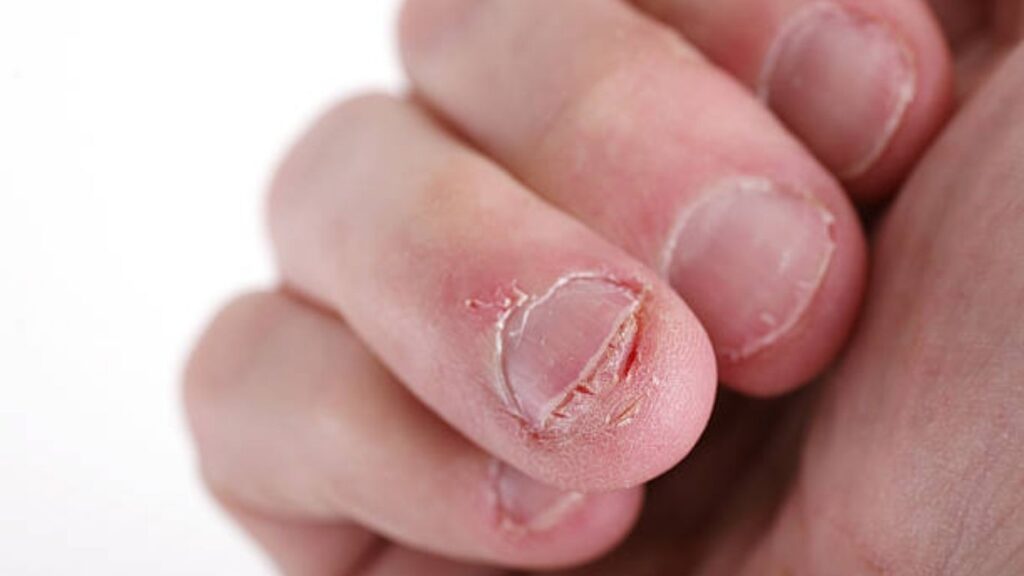 Móng tay bị tổn thương 